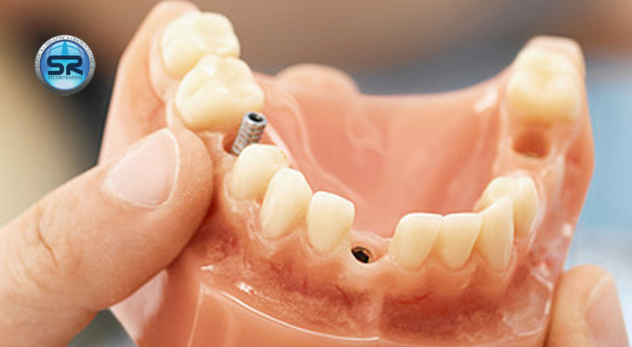 Cos'è un impianto dentale